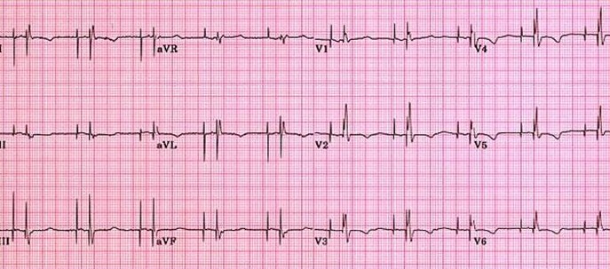 Single chamber pacemaker atrial fibrillation