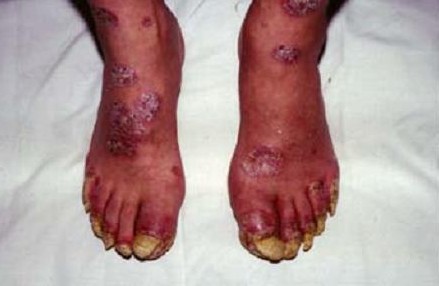 Typical psoriatic skin lesions in patient with arthritis affecting the feet. (courtesy Dr. I. Dwosh)