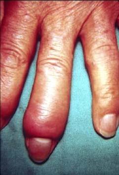 Dactylitis (image courtesy of Dr. I. Dwosh)