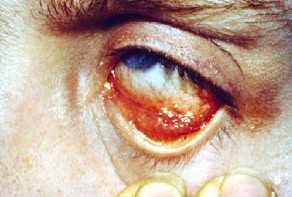 Conjunctivitis in a patient with Reiter's syndrome. (courtesy Dr. I. Dwosh)