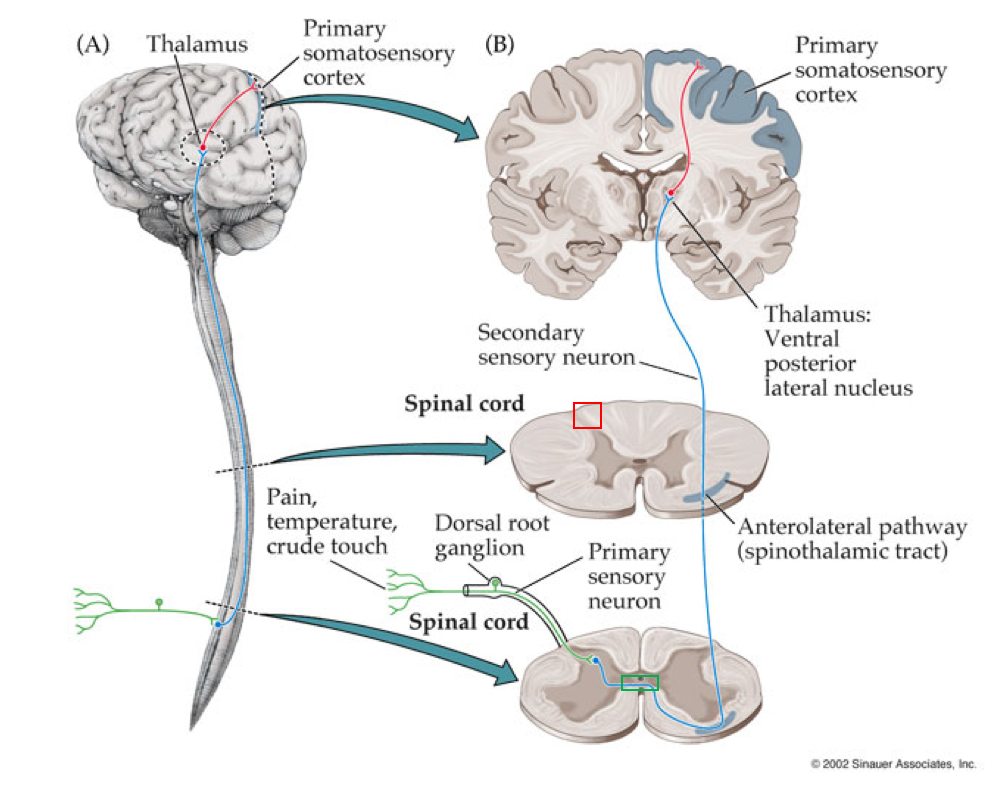 The anterolateral pathway 
</img>
1) Pain stimuli to primary afferent in DRG
2) ascend ipsilateral several spinal levels in Lissauer's tract 
3)synapse on the second order neuron in the dorsal horn 
4) cross the midline at ventral white commissure in spinal cord 
5) second order neuron ascends the contralateral spinal cord through the contralateral lateral funiculus
6) second order axon ascends through the lateral thalamic tract
7)second order neuron synapses at VPL to join third order neuron
8) third order neuron ascends and synapses at 4th order neuron in contralateral somatosensory cortex